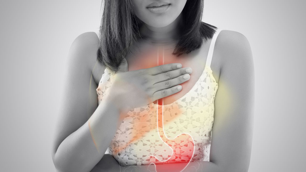 GERD and Acid Reflux: Everything You Need to Know