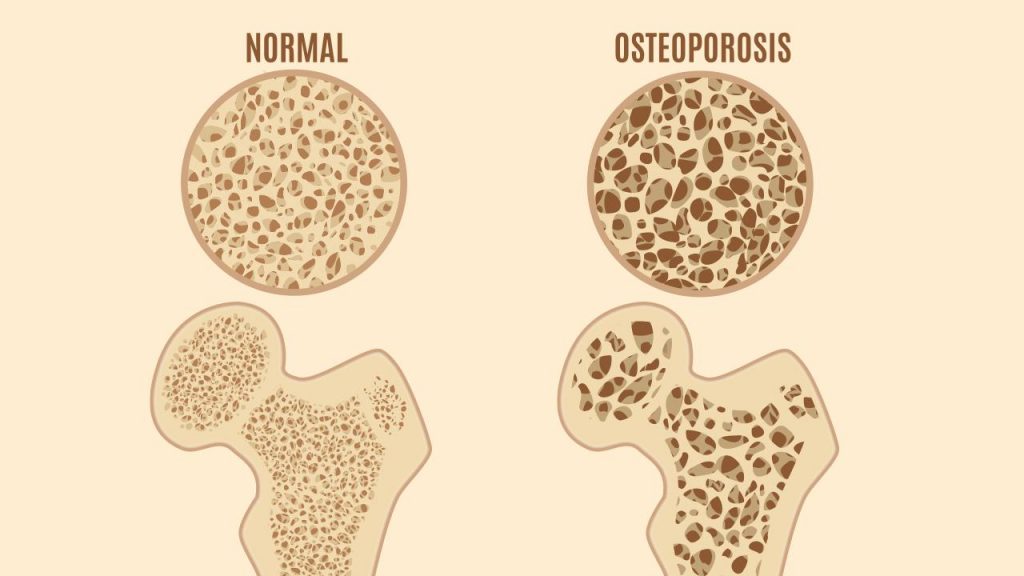 normal bone vs osteoporosis
