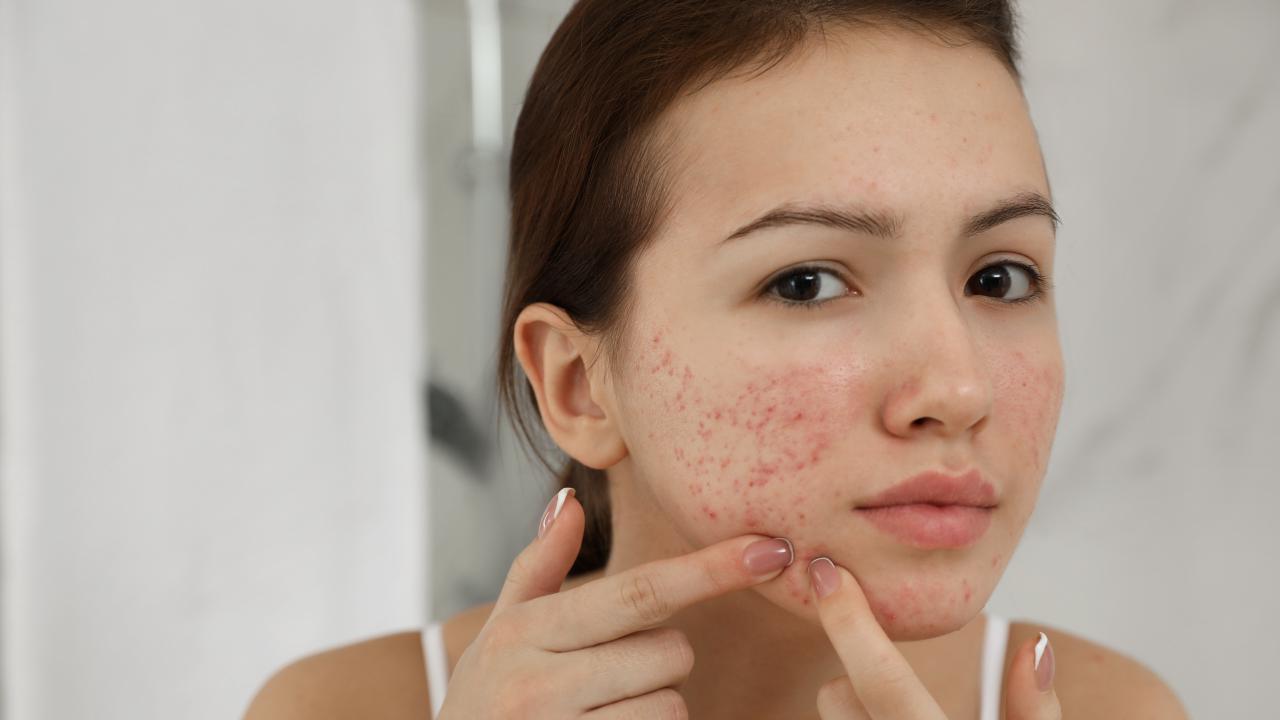 How to prevent acne