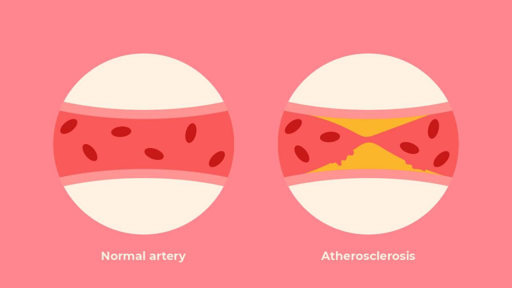 Arteriosclerosis and atherosclerosis