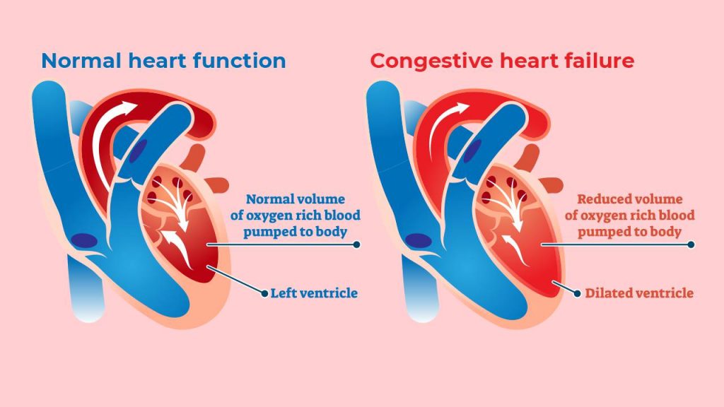 congestive heart failure (CHF)