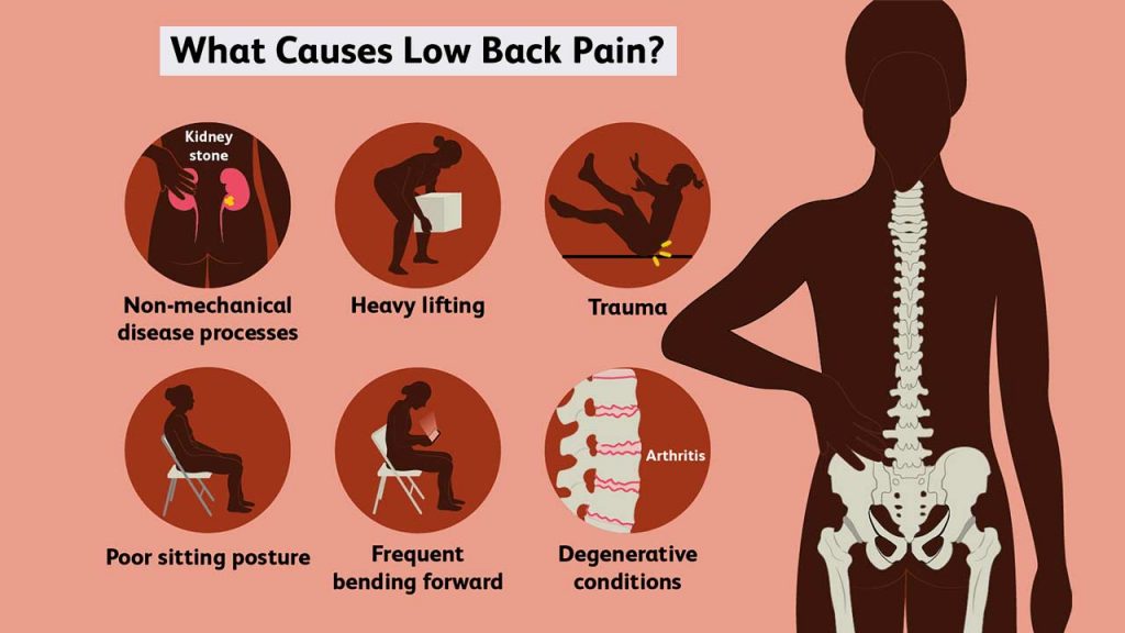 Some common causes of lower back pain. 
