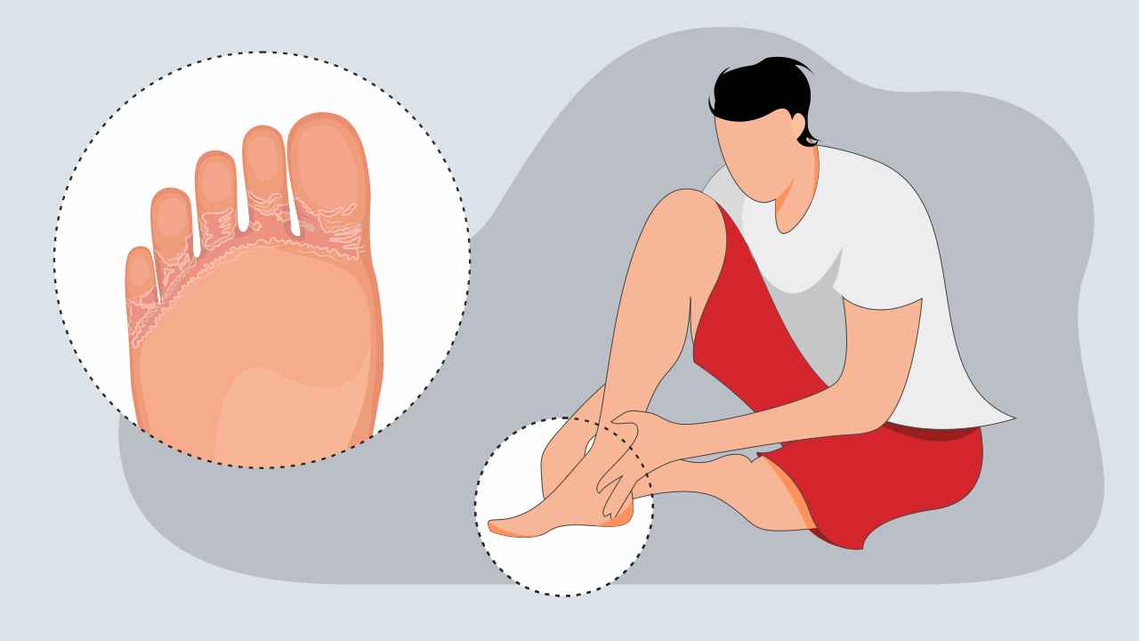 Athlete’s Foot: Causes, Treatment, and Prevention