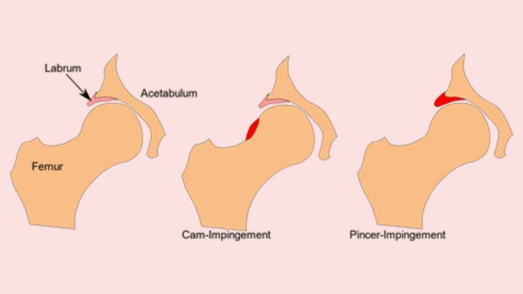 types of femoral-acetabular impingement