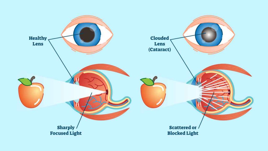 Effect of cataract on vision