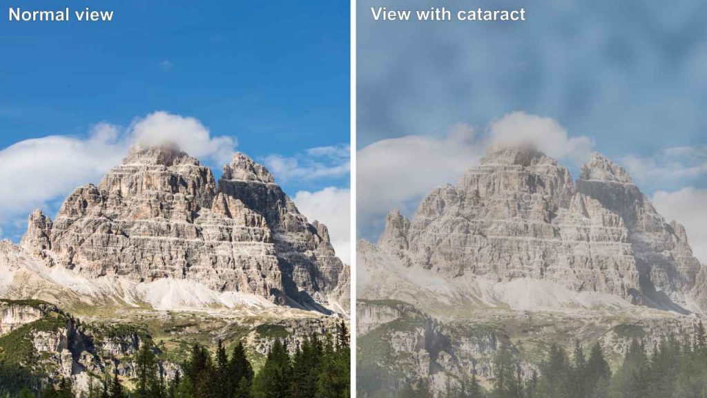 Difference between normal vision and vision with cataract