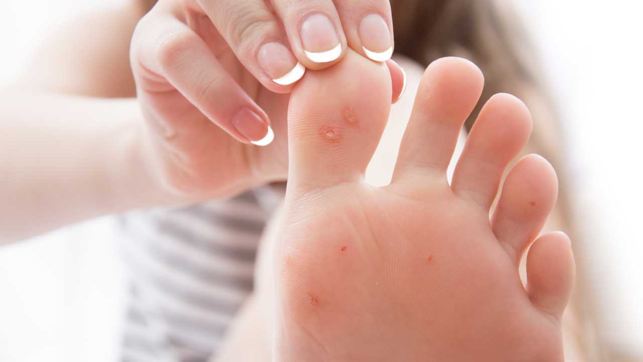 Corns and Calluses: Symptoms, Causes, and Prevention