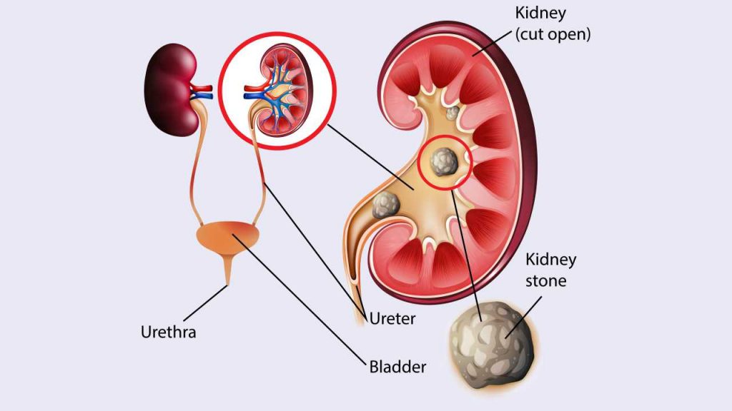 kidney stones formation