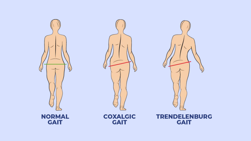 Figure 2. Coxalgic and Trendelenburg gait patterns compared to normal gait